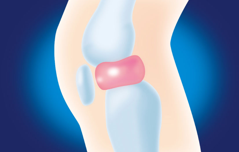 正常なひざ軟骨