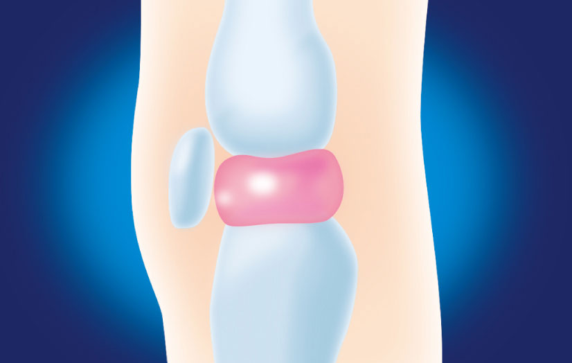 軟骨が復活してクッションに