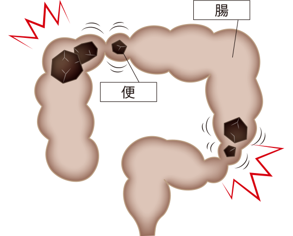 けいれん性便秘